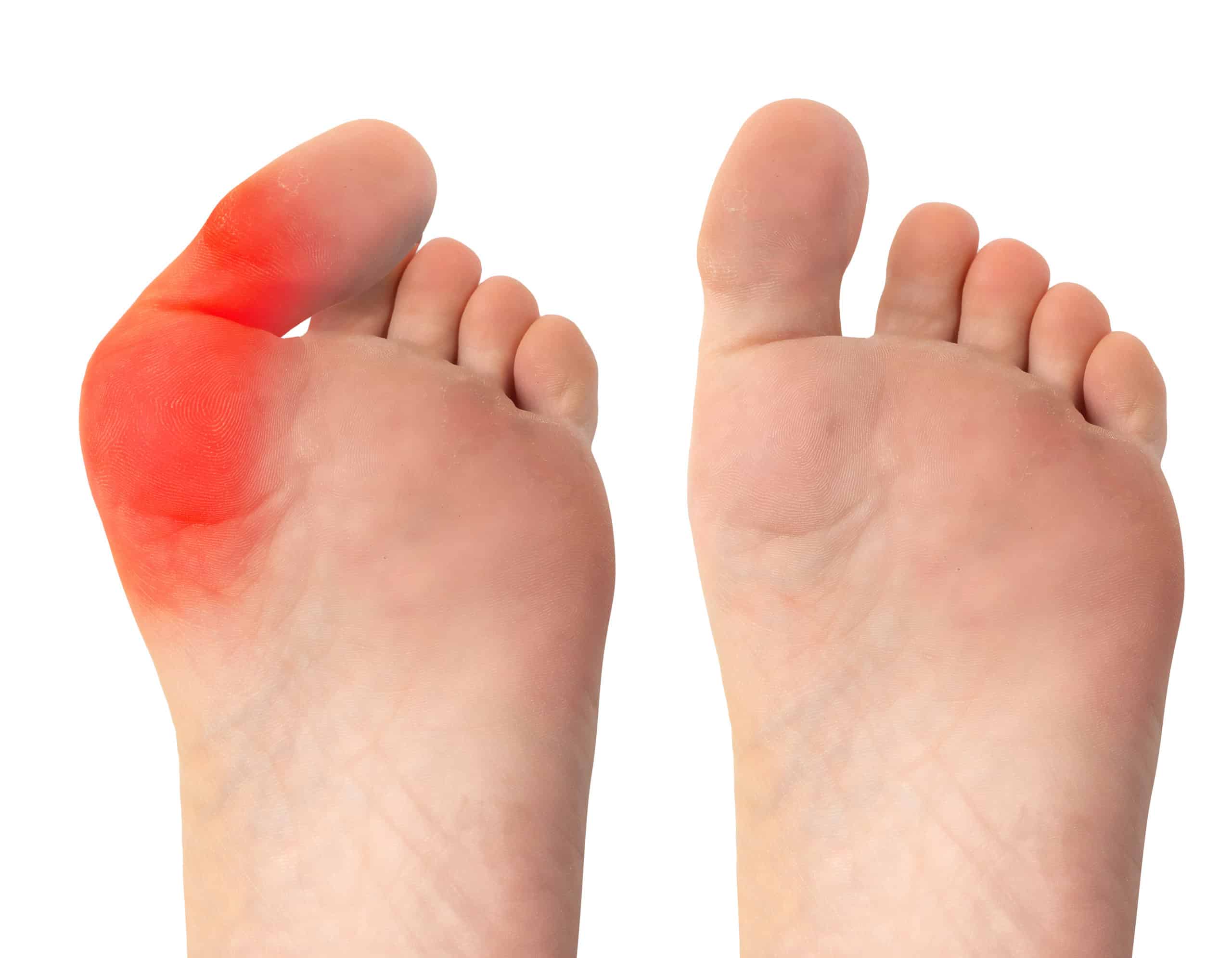 Before - after hallux valgus surgery 2020