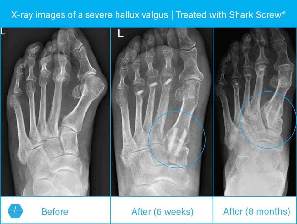 X-ray images before and after hallux valgus surgery / lapidus arthrodesis with Shark Screw®.