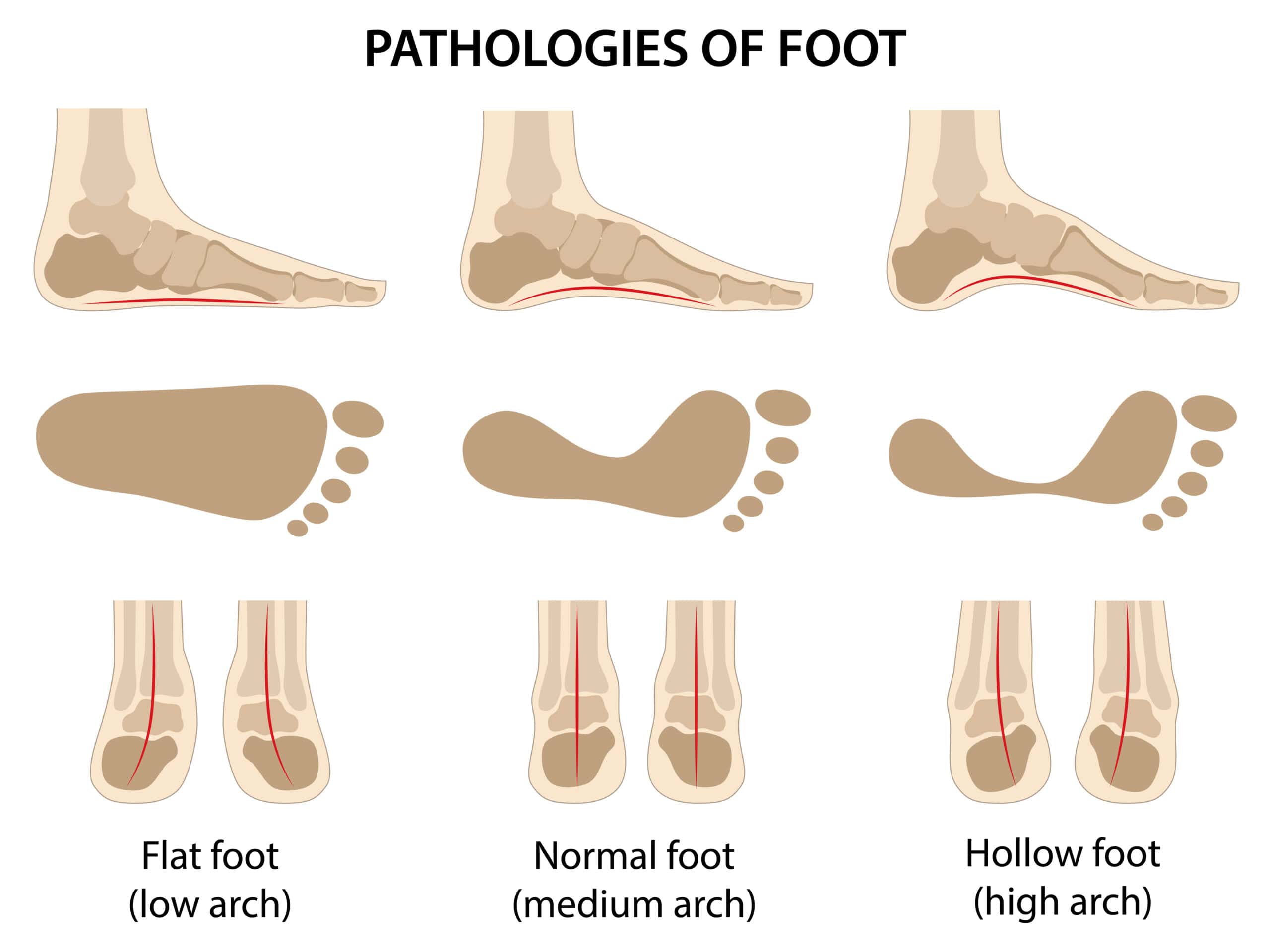Pathologies of foot. Flat foot. Difference between sick and healthy feet.
